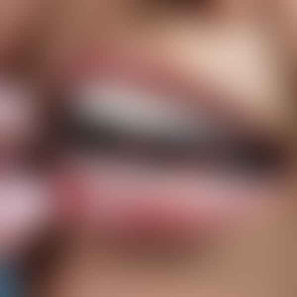 Keeping Your Braces in Top Shape: How to Put Wax on Braces