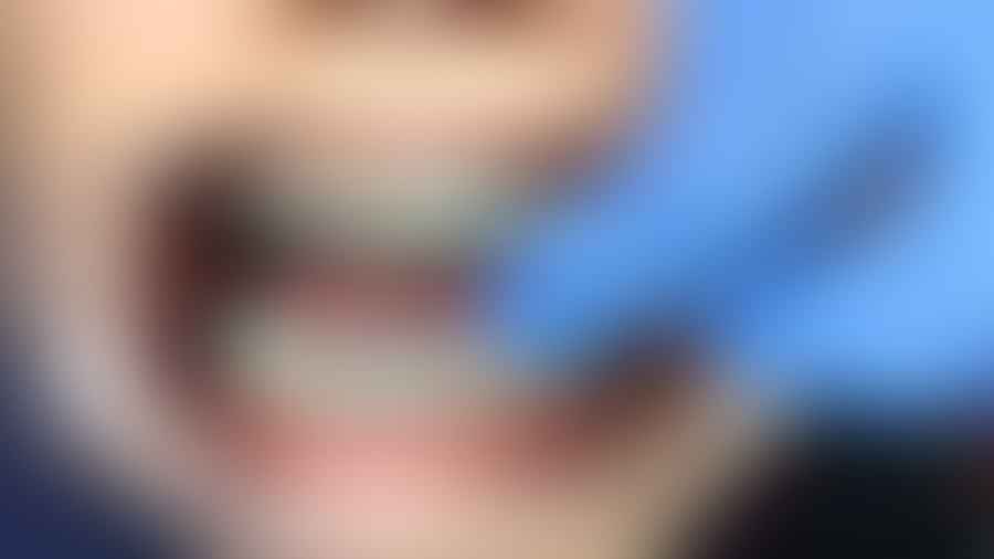 Close-up of hands using a floss threader on braces